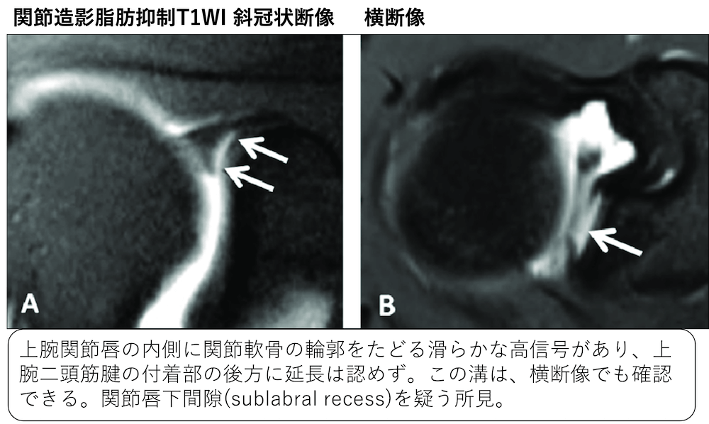 関節唇および肩甲上腕靱帯の正常変異とMRI画像所見のポイント
